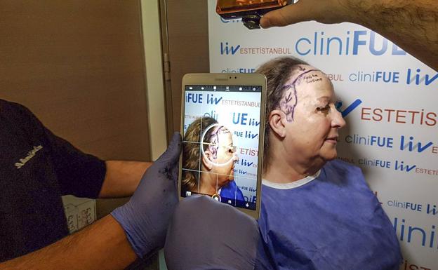 De Cantabria a Turquía en busca de pelo