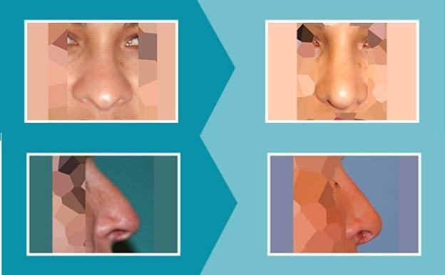 Rinoplastia ultrasónica
