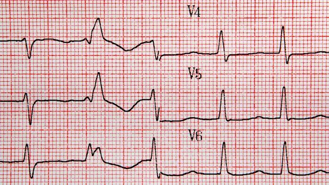 ¿Es efectiva la ablación de la fibrilación auricular?