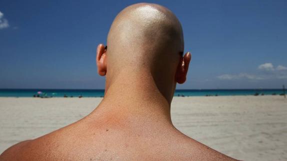 La piel de la calva es más sensible y propensa a las quemaduras