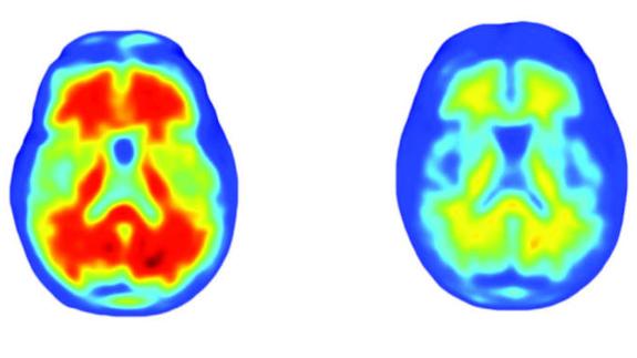 Un fármaco en pruebas frena el deterioro cognitivo del Alzheimer