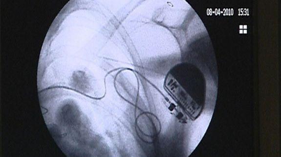 Mini paneles solares, el siguiente reto en dispositivos médicos